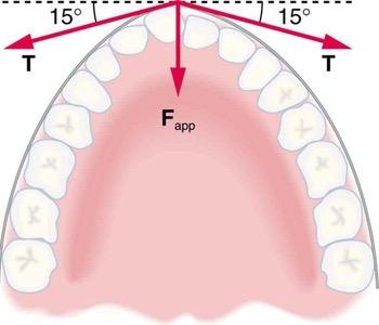 <b>Figure 4.38</b> Braces are used to apply forces to teeth to realign them. Shown in this figure are the tensions applied by the wire to the protruding tooth. The total force applied to the tooth by the wire, F_{app}, points straight toward the back of the mouth.